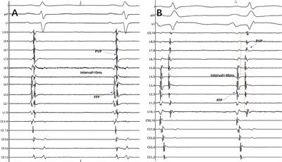 Novel Clue to Locate Conduction Gaps in the Pulmonary Vein Isolation Ablation Line